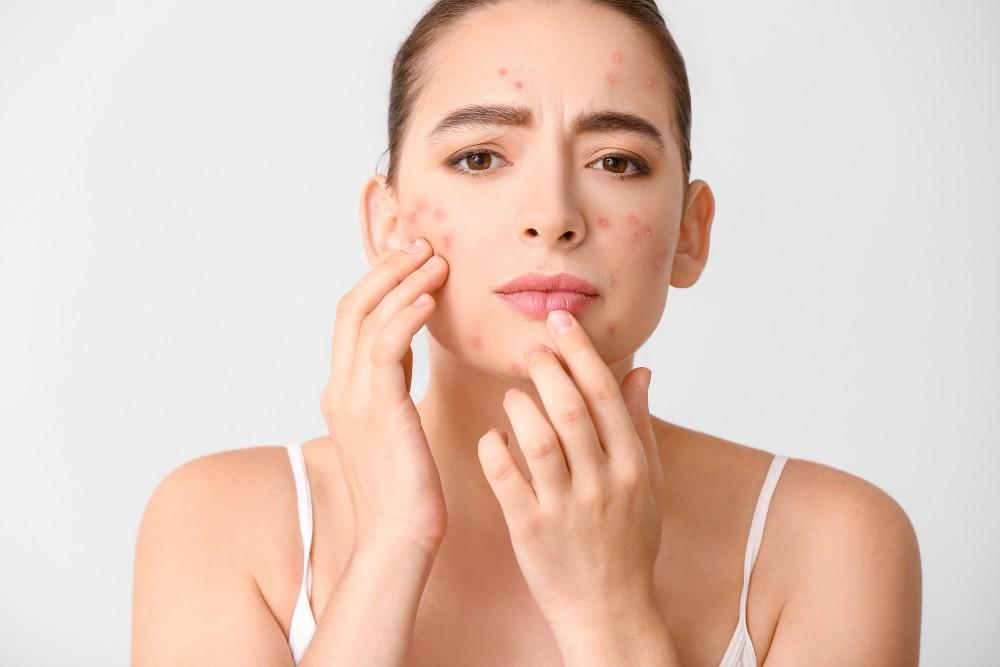 A woman with acne, looking concerned, seeking solutions for Skin Rejuvenations.