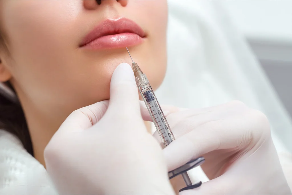 Lip enhancement with Injectables, as a syringe is used for lip filler injection to improve shape and volume.